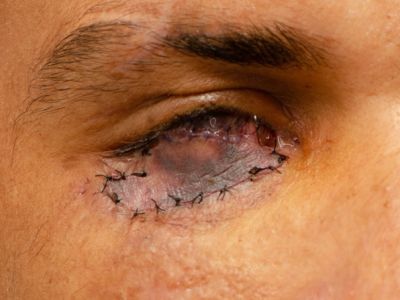 5 días postoperatorio de colgajo tarsoconjuntival de Hughes con injerto libre de piel retroauricular.