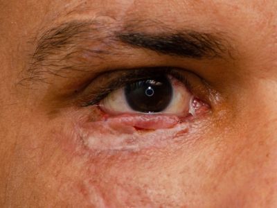 1 mes postoperatorio de colgajo tarso-conjuntival de Hughes con injerto libre de piel retroauricular luego de apertura de Hughes.