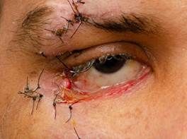 Trauma palpebral con pérdida de párpado inferior.